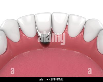 3d rendu de la mâchoire humaine avec la maladie de péri implantis sur fond blanc Banque D'Images