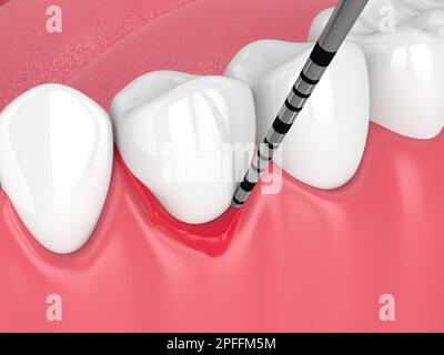 3d rendu de la mâchoire humaine avec la maladie de péri implantis et la sonda parodontale Banque D'Images