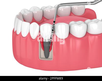 3d rendu de la mâchoire humaine avec la maladie de péri-implantite et de la sonda parodontale sur fond blanc Banque D'Images