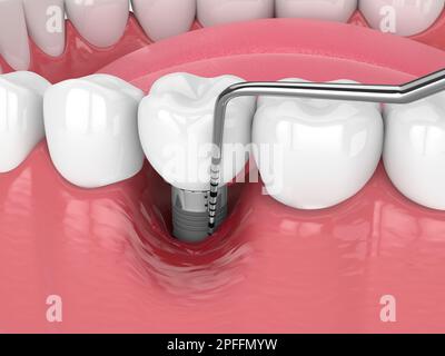 3d rendu de la mâchoire humaine de proximité avec la maladie de périimplantite et la sonda parodontale Banque D'Images