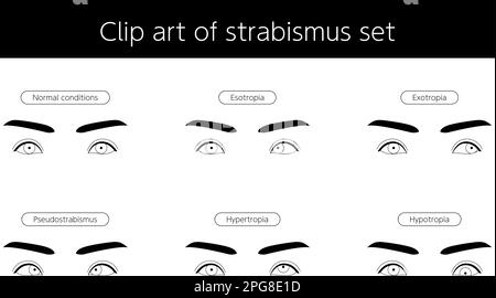 Illustration médicale, maladies oculaires et strabisme de l'ensemble d'illustrations, illustration vectorielle Illustration de Vecteur