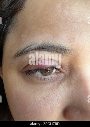 vue rapprochée d'une paupière gonflée due à une infection bactérienne, yeux rouges enflés et irritables, stylet rouge douloureux. Banque D'Images