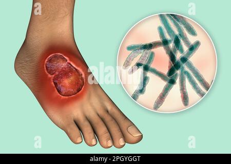 Ulcère de Buruli et Mycobacterium ulcerans, illustration Banque D'Images