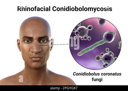 Conidiolomycose rhinofaciale et champignon, illustration Banque D'Images