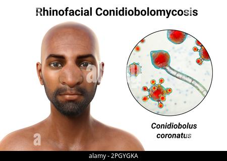 Conidiolomycose rhinofaciale et champignon, illustration Banque D'Images