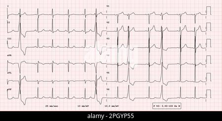 Exemple ECG de rythme 12 dérivations, examen de bigéminisme ventriculaire, réel Banque D'Images