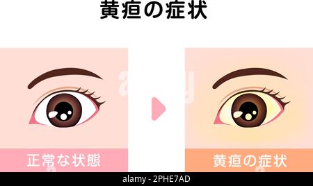 Illustration de comparaison des yeux normaux et jaundés Illustration de Vecteur