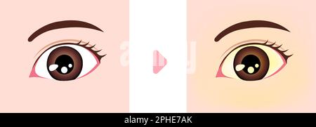 Illustration de comparaison des yeux normaux et jaundés Illustration de Vecteur