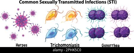 Illustration des infections sexuellement transmissibles courantes (ITS) Illustration de Vecteur