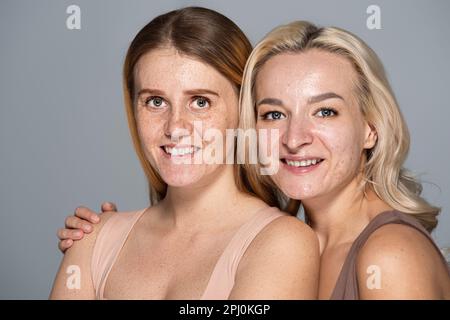 Portrait de la femme blonde avec la peau problématique embrassant ami souriant avec visage naufré isolé sur gris, image de stock Banque D'Images