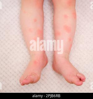 Soins de la peau, allergies et dermatites pour tout-petits. Taches rouges d'allergie et de dermatite atopique sur la peau de l'enfant. Enfant âgé d'un an et de huit mois Banque D'Images