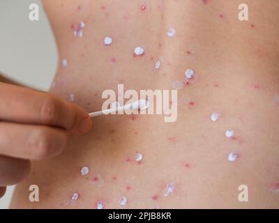 Une main de mère tenant un coton-tige et frottant la varicelle cloques sur la peau de l'adolescent avec la lotion de la Calamine. Banque D'Images