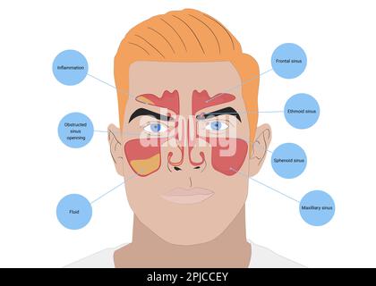 Illustration d'un homme avec des sinus paranasaux sains et inflammatoires sur fond blanc Banque D'Images