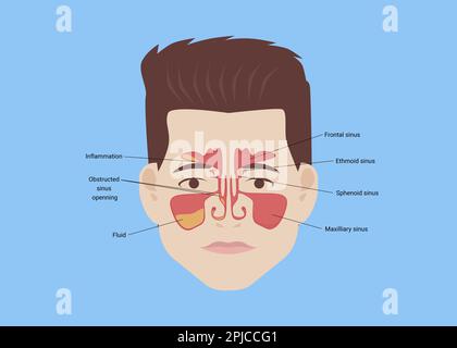 Illustration d'un homme avec des sinus paranasaux sains et inflammatoires sur fond bleu clair Banque D'Images