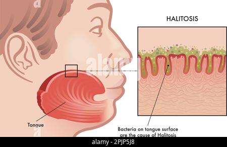 Illustration médicale de la cause de l'halitose Illustration de Vecteur