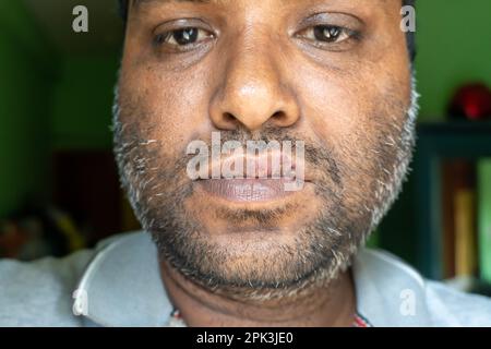 Une plaie froide sur la lèvre d'un homme d'âge moyen. Les lèvres d'un homme d'âge moyen présentaient des ampoules de fièvre. Banque D'Images