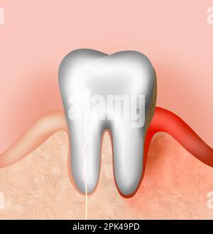 Gomme et dent infectées, illustration. Maladie parodontale Banque D'Images