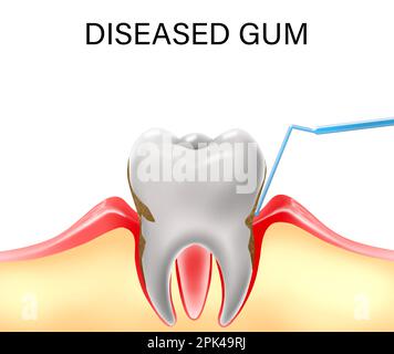 Gomme et dent infectées, illustration. Maladie parodontale Banque D'Images