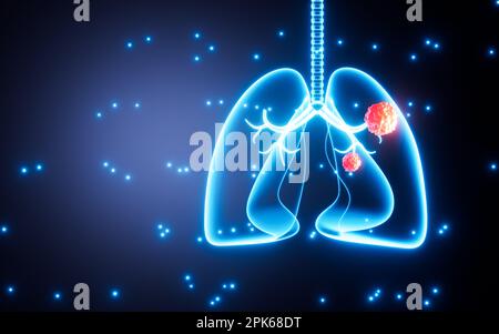 Tumeur pulmonaire humaine, cancer du poumon humain, rendu 3D. Dessin numérique. Banque D'Images