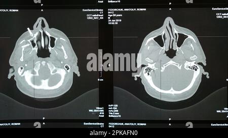 Imagerie par résonance magnétique du cerveau d'un homme plus âgé après une lésion cérébrale traumatique, ce qui montre que le cerveau est endommagé. Image tomographique de la tête. Examen par un neurologue Banque D'Images