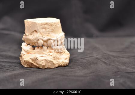 Modèle de plâtre ou fonte de dents humaines. Dents fortement tordues. Banque D'Images