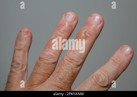 Ampoules typiques de la peau provenant de brûlures d'huile bouillante au deuxième degré. Banque D'Images