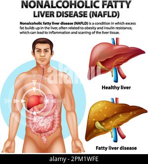 Illustration de la stéatose hépatique non alcoolique Illustration de Vecteur