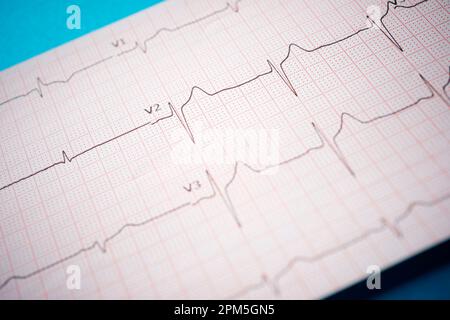 Électrocardiogramme imprimé sur papier sur une table bleue. Banque D'Images