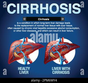 Cirrhose du foie Illustration infographique Illustration de Vecteur