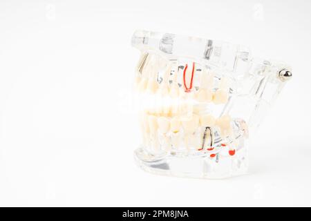 Les prothèses dentaires, les dents et les prothèses humaines sur fond blanc. Banque D'Images