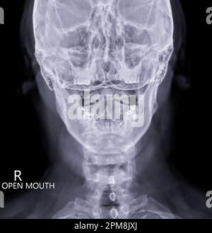 Radiographie du rachis cervical ou image radiographique du rachis cervical vue ouverte pour la fracture de la vertèbre cervicale 2nd ( axe ). Banque D'Images