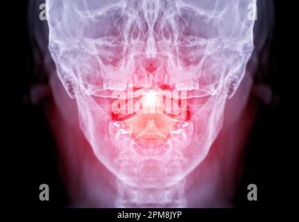 Radiographie du rachis cervical ou image radiographique du rachis cervical vue ouverte pour la fracture de la vertèbre cervicale 2nd ( axe ). Banque D'Images