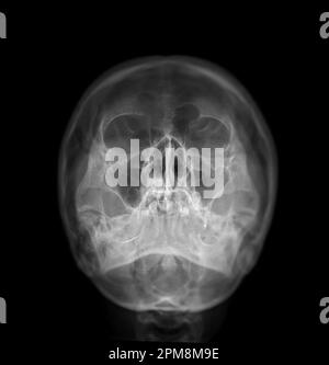 Image à rayons X de la vue de l'eau du crâne humain pour le diagnostic de fracture du crâne isolée sur fond noir. Banque D'Images