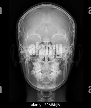 Image à rayons X du crâne humain vue de face pour le diagnostic de fracture du crâne isolée sur fond noir. Banque D'Images