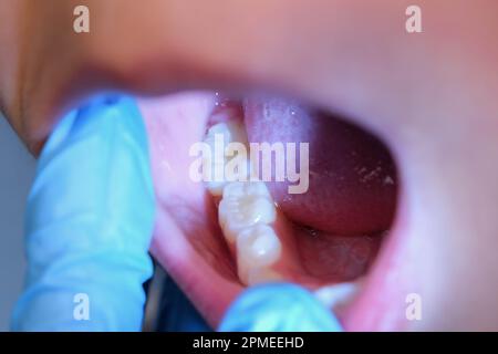 Gros plan à l'intérieur de la cavité buccale d'un enfant en bonne santé avec de belles rangées de dents de bébé. Jeune fille ouvre la bouche révélant les dents supérieures et inférieures, PAL dur Banque D'Images