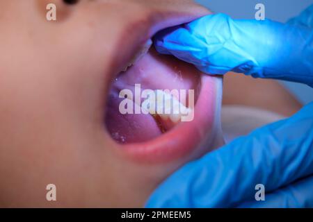 Gros plan à l'intérieur de la cavité buccale d'un enfant en bonne santé avec de belles rangées de dents de bébé. Jeune fille ouvre la bouche révélant les dents supérieures et inférieures, PAL dur Banque D'Images