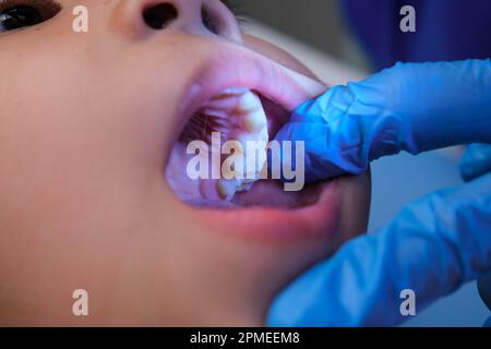 Gros plan à l'intérieur de la cavité buccale d'un enfant en bonne santé avec de belles rangées de dents de bébé. Jeune fille ouvre la bouche révélant les dents supérieures et inférieures, PAL dur Banque D'Images