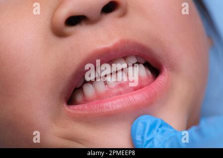 Gros plan à l'intérieur de la cavité buccale d'un enfant en bonne santé avec de belles rangées de dents de bébé. Jeune fille ouvre la bouche révélant les dents supérieures et inférieures, PAL dur Banque D'Images