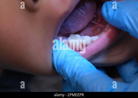 Gros plan à l'intérieur de la cavité buccale d'un enfant en bonne santé avec de belles rangées de dents de bébé. Jeune fille ouvre la bouche révélant les dents supérieures et inférieures, PAL dur Banque D'Images