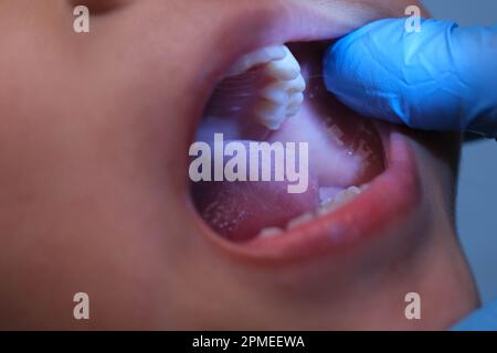 Gros plan à l'intérieur de la cavité buccale d'un enfant en bonne santé avec de belles rangées de dents de bébé. Jeune fille ouvre la bouche révélant les dents supérieures et inférieures, PAL dur Banque D'Images