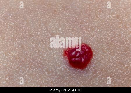 Mole rouge sur la peau vue rapprochée extrême, macro Banque D'Images