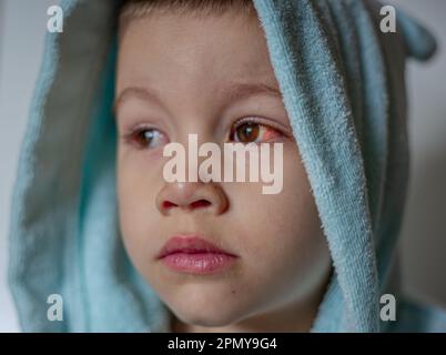 Un jeune enfant aux yeux avariés souffre de conjonctivite.gros plan d'un oeil de sang sévère.Londres Angleterre Banque D'Images