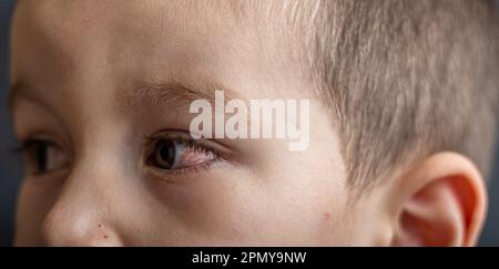 Un jeune enfant aux yeux avariés souffre de conjonctivite.gros plan d'un oeil de sang sévère.Londres Angleterre Banque D'Images