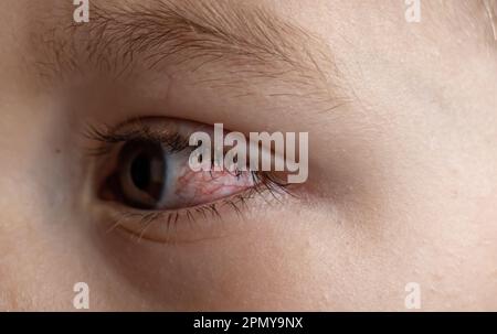 Un jeune enfant aux yeux avariés souffre de conjonctivite.gros plan d'un oeil de sang sévère.Londres Angleterre Banque D'Images