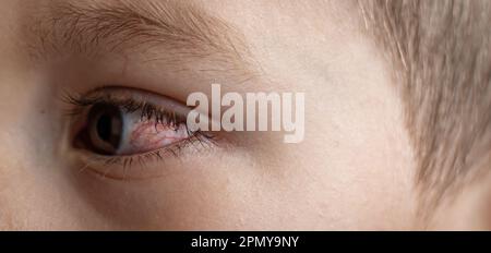 Un jeune enfant aux yeux avariés souffre de conjonctivite.gros plan d'un oeil de sang sévère.Londres Angleterre Banque D'Images