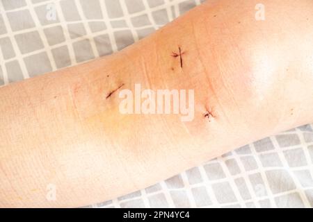 Sutures postopératoires sur le genou et la jambe inférieure après le remplacement du ménisque chez un homme, incisions cousues Banque D'Images