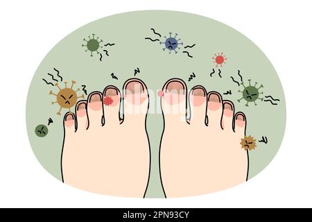 Les pieds de la personne avec une maladie ou une infection des ongles. Pied avec onychomycose ou champignon sur les doigts. Traitement et procédure médicaux. Concept de santé et de médecine. Illustration vectorielle plate. Illustration de Vecteur