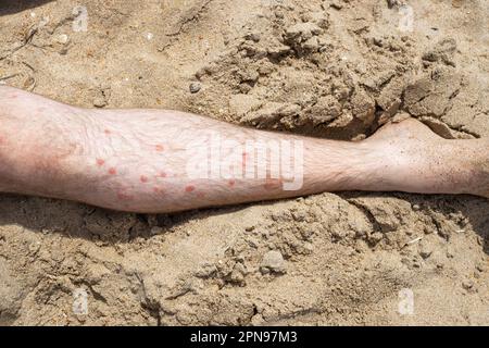 de nombreux ulcères rouges et squameux sur la jambe d'un homme. Maladie immunitaire psoriasis et traitement UV lors d'une journée d'été sur le sable de mer. Banque D'Images