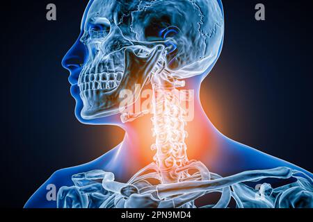 Vertèbres cervicales avec arthrose, inflammation ou blessure 3D illustration de rendu. Anatomie, pathologie de la colonne vertébrale, douleur ou maladie articulaire, rhumatisme articulaire Banque D'Images