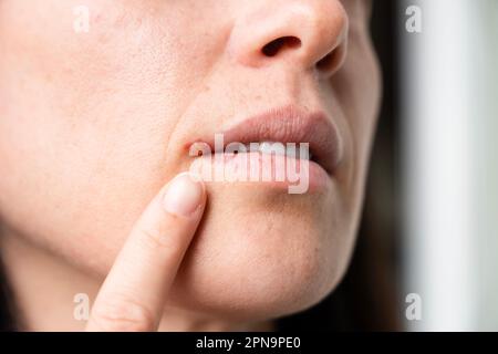 La femme avec un virus herpès sur les lèvres. Ampoules d'herpès. Banque D'Images